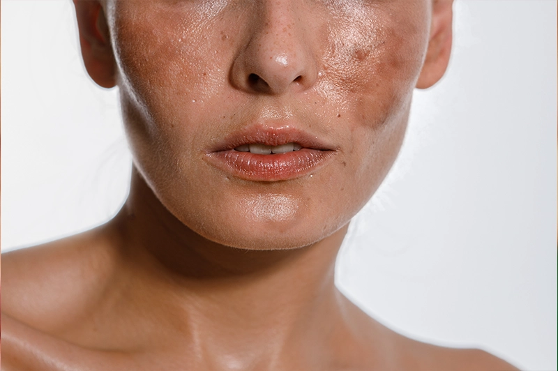 Melasma