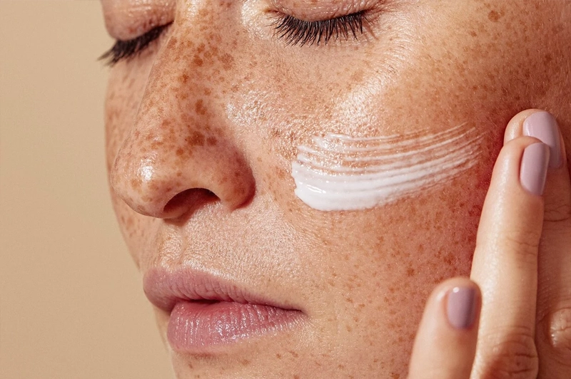 Mancha solar ou melasma