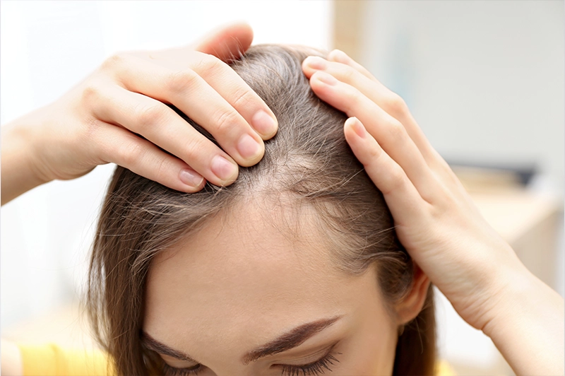 Queda de cabelo em mulheres